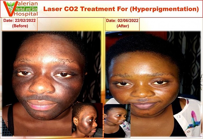 Hyperpigmentation