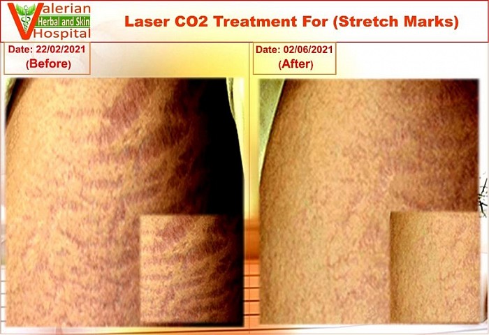 Stretch Marks Treatment