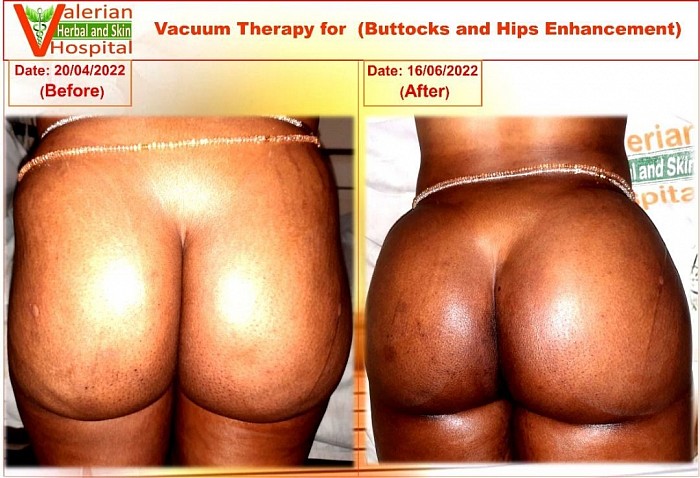 Buttocks Enhancement