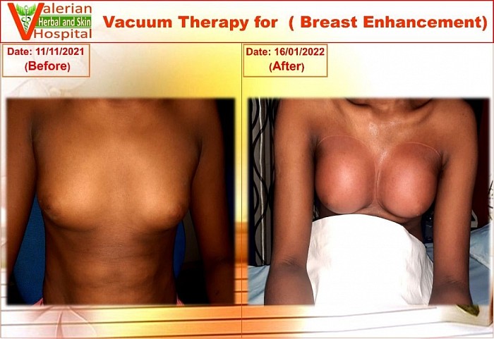 Breast Enhacement